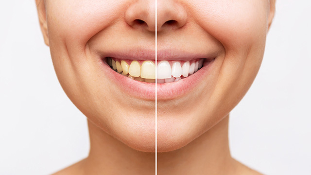 The image shows a split-screen comparison of a person s face before and after what appears to be a cosmetic dental treatment, highlighting the transformation with text.