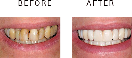 The image shows a comparison of two dental procedures, with one side displaying teeth before treatment and the other after, illustrating the results of cosmetic dentistry.
