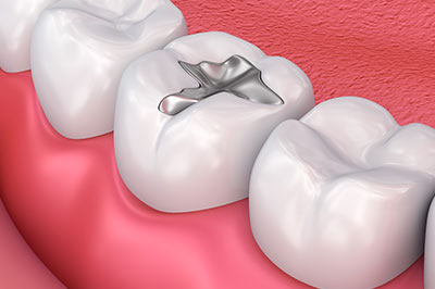 An image of a dental implant with a screw inserted into a simulated tooth socket, set against the backdrop of a pink oral cavity with teeth and gums.