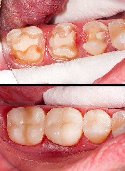 A close-up of a person s mouth with a focus on dental issues, showcasing yellowing and stained teeth.