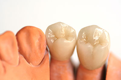 Dental implant and tooth crowns with a close-up view of artificial teeth.