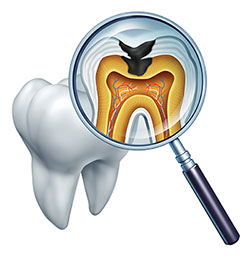 An illustration of a magnified tooth with an open cavity, showcasing the interior structure and gumline, viewed through a magnifying glass.