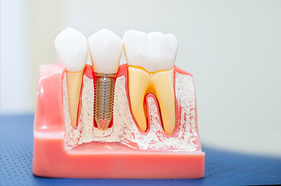 The image shows a dental implant fixture with multiple tooth-like structures, one of which has a screw and a crown-like structure in place, set against a pink background that resembles a mouth or gumline.