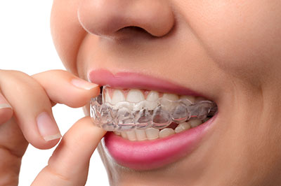 The image shows a person with a smile, holding an oral appliance to their teeth.