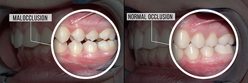 Before and after dental implant comparison, showing a patient s teeth with an overlay of the implant process.