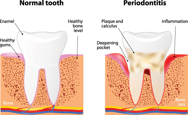 The image presents a detailed scientific illustration of the human mouth in three stages  normal, periodontitis, and bone loss. It is labeled with annotations explaining each stage, highlighting the progression of dental health issues from healthy to severe.