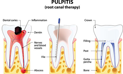 The image is a medical illustration showing the anatomy of a tooth and its root canal therapy, with labels indicating various parts such as dental caries, inflammation, crown, filling, and vessels.