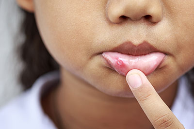 The image features a young child with a visible acne blemish on their face, holding their finger near the blemish.