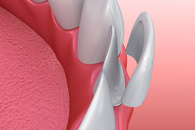 The image features a close-up of a dental implant or prosthetic tooth with visible screws, set against a pink background that resembles gum tissue.