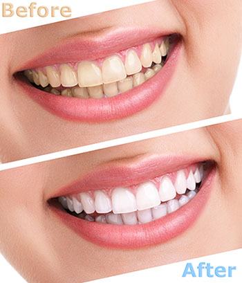 The image shows a before and after comparison of dental teeth whitening, with the  before  showing yellowed teeth and the  after  displaying bright white teeth.