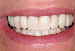 The image shows a close-up of a person s smiling mouth, revealing white teeth and pink gums.