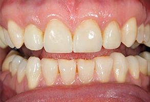 The image shows a close-up view of a person s teeth with a focus on the lower front teeth, which appear to be discolored or stained.