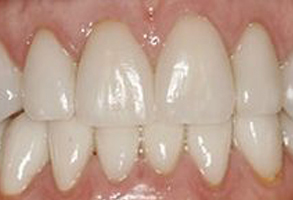 The image shows a close-up of a person s teeth, revealing a bright smile with white teeth and yellow stains on the front teeth.