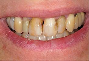 An image of a person s mouth with severely discolored teeth, showcasing a dental condition.