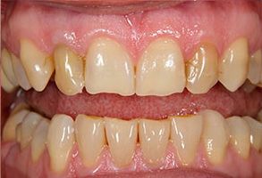 The image shows a close-up of a person s teeth with a focus on the top row, where there is visible discoloration and staining.