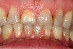 The image shows a close-up of a person s teeth with visible staining and discoloration, specifically focusing on the front teeth.