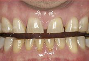 An image of a person s teeth with visible wear and discoloration, showcasing a dental condition.